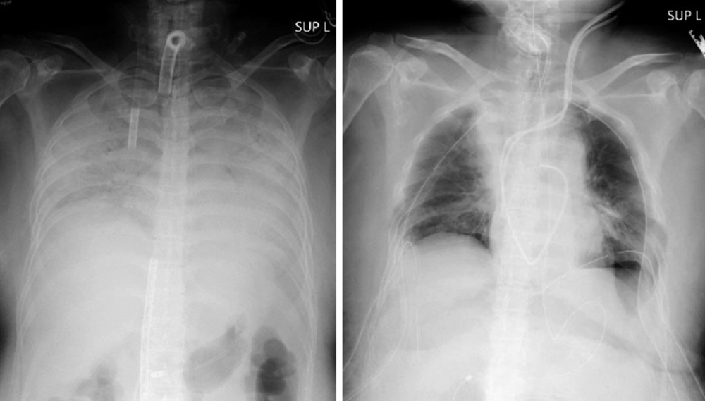 صورة الأشعة السينية للمريضة (على اليمين بعد العملية - وعلى اليسار قبلها) | عبر مستشفى جامعة كيوتو و وكالة كيودو